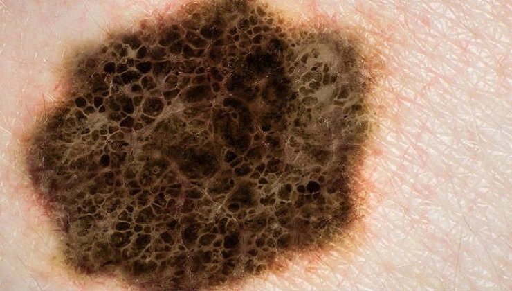 These two drugs can eliminate one in five Skin Cancer Tumours